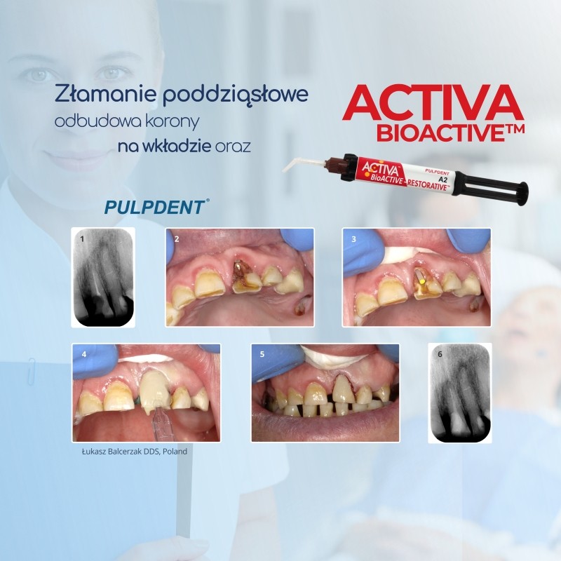 ACTIVA BioACTIVE - Restorative - bioaktywne wypełnienie