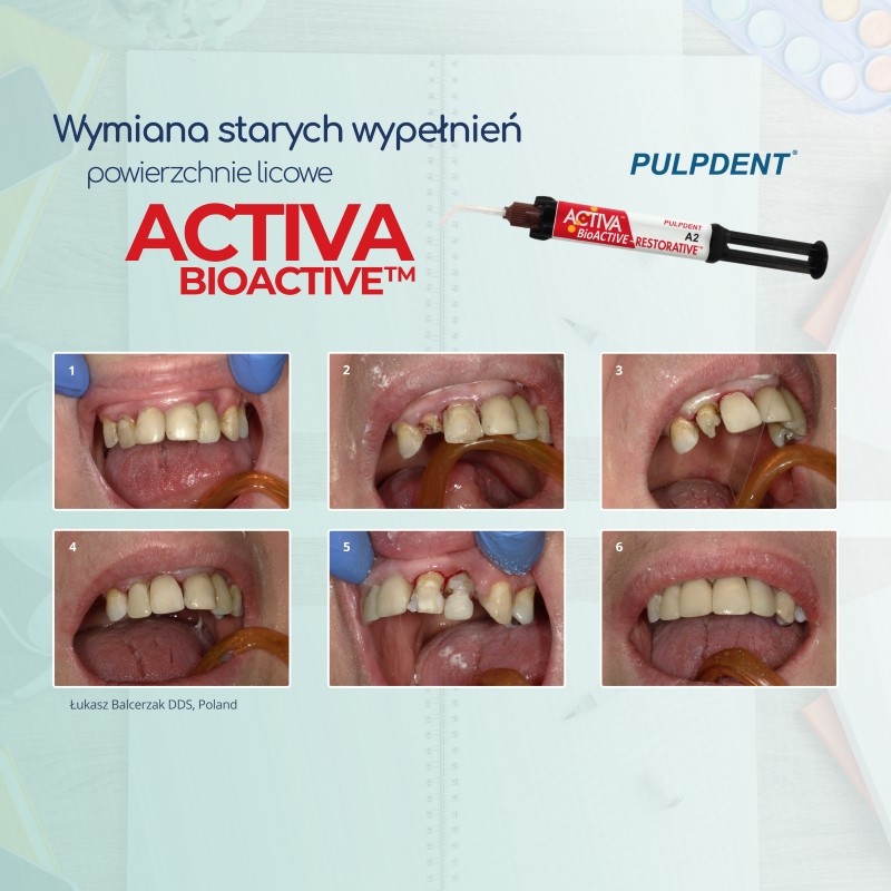 ACTIVA BioACTIVE - Restorative - bioaktywne wypełnienie