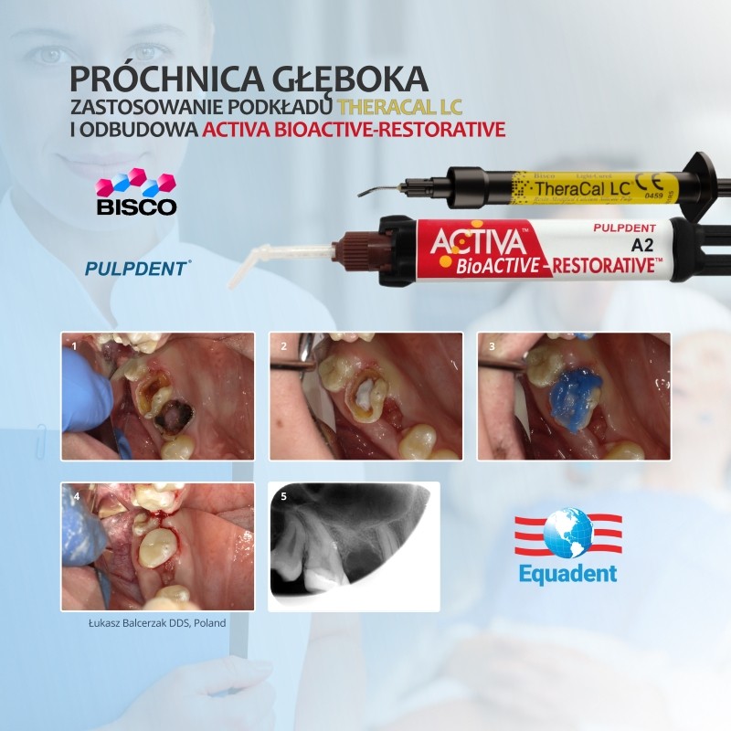 ACTIVA BioACTIVE - Restorative - bioaktywne wypełnienie